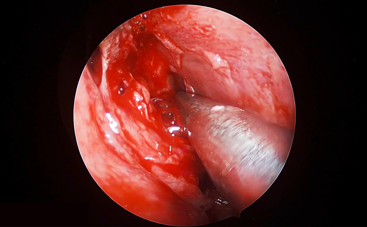 4K超高清內窺鏡攝像系統(tǒng)在腦垂體瘤切除術中的精彩表現(xiàn) 4K超高清內窺鏡攝像系統(tǒng)在腦垂體瘤切除術中的精彩表現(xiàn)