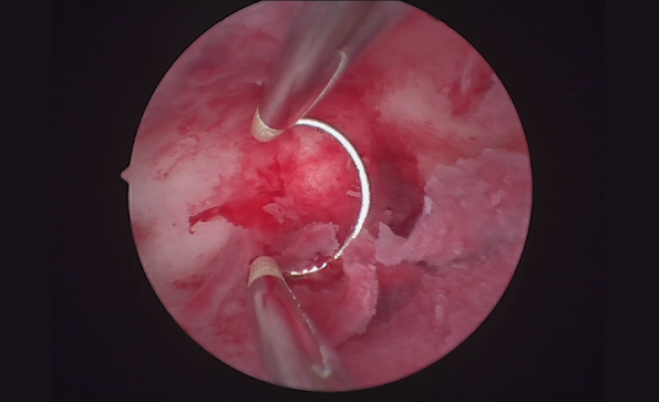 宮腔鏡系統(tǒng)包括哪些設(shè)備？如何消毒？